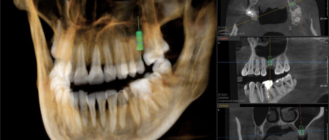 Unikátní OPG a CBCT systém VATECH PaX- i3D Smart