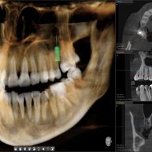 Компьютерная томография